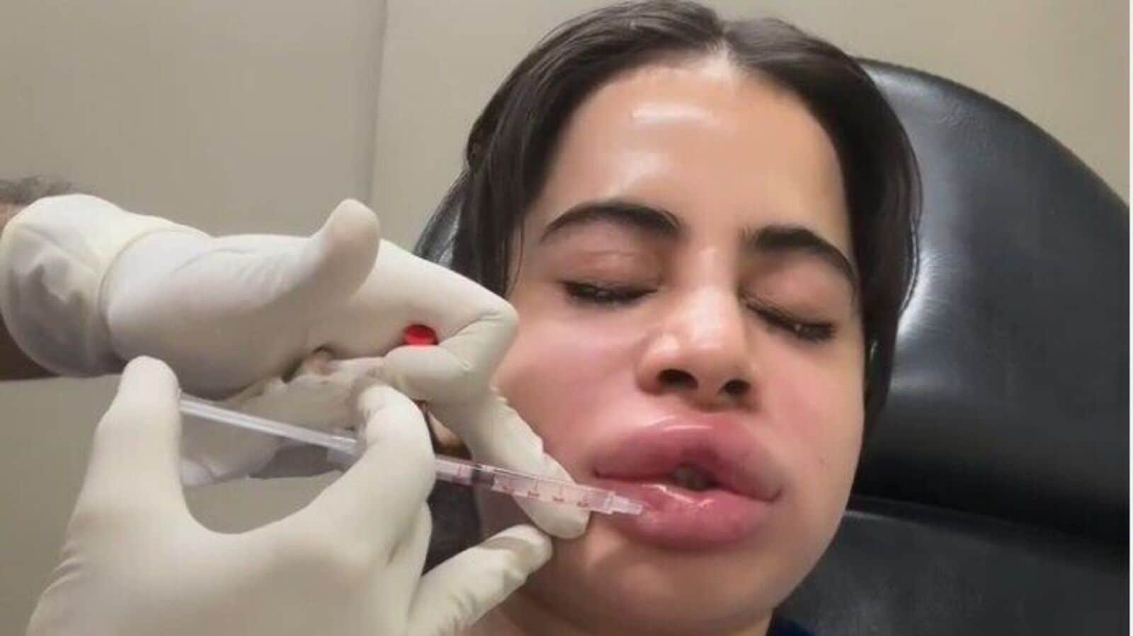 Social media influencer Urfi Javed documented her painful lip filler dissolution process online.