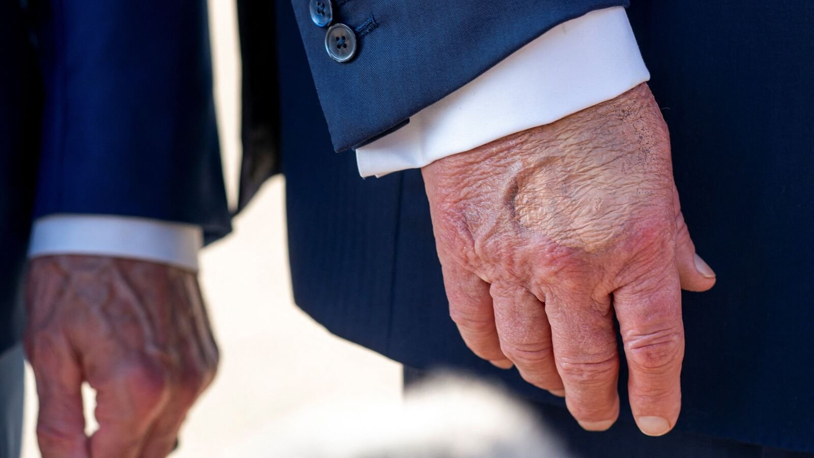 FILE PHOTO: Make-up partially covers the back of the right hand of U.S. President Donald Trump as he speaks to members of the media upon his arrival from Pennsylvania, at Joint Base Andrews, Maryland, U.S., July 15, 2025. In a July 17, 2025 press briefing, U.S. Press Secretary Karoline Leavitt read a statement from his doctor that President Trump has a chronic venous insufficiency'. REUTERS/Nathan Howard/File Photo