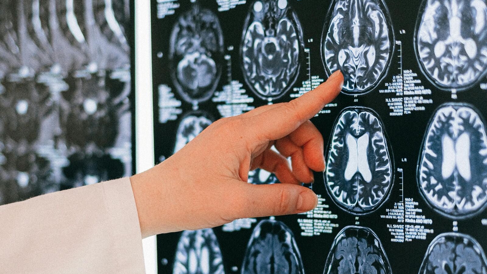 Gliomas are malignant or cancerous tumours, although some grow very slowly.