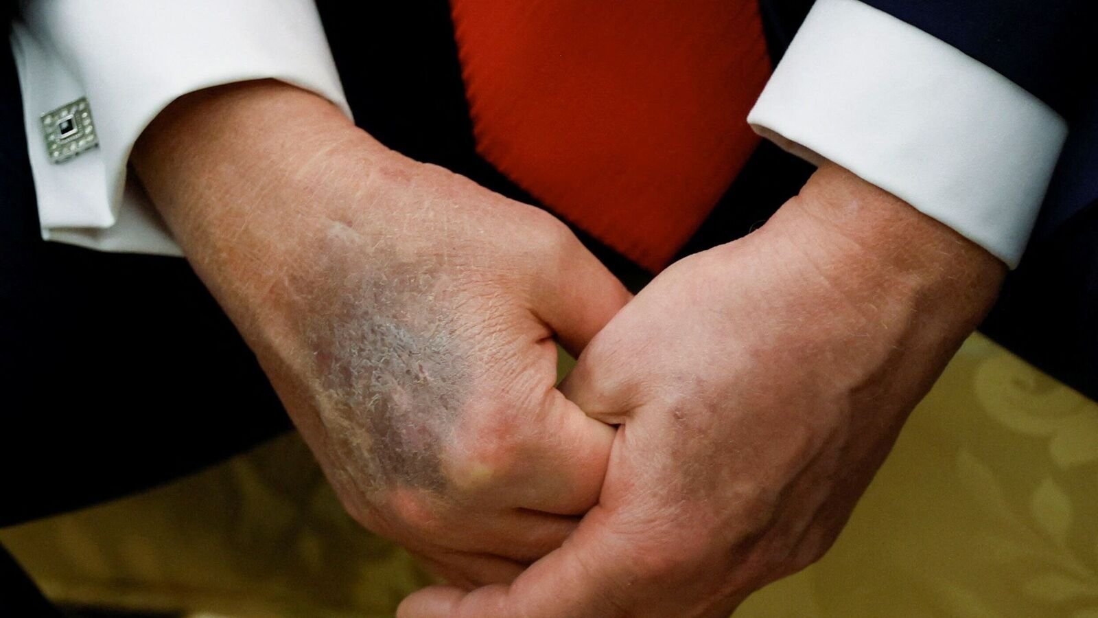 The bruised right hand of U.S. President Donald Trump is visible during a meeting with South Korean President Lee Jae Myung at the Oval Office, at the White House, in Washington, D.C., U.S., August 25, 2025. REUTERS/Brian Snyder