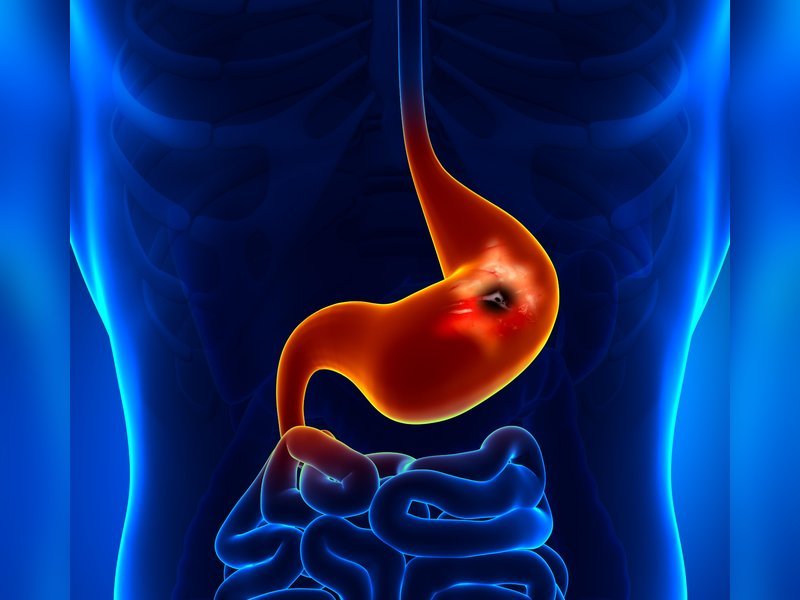 पेट की जलन, दर्द और भारीपन को नजरअंदाज न करें, अल्सर संकेत हो सकते हैं