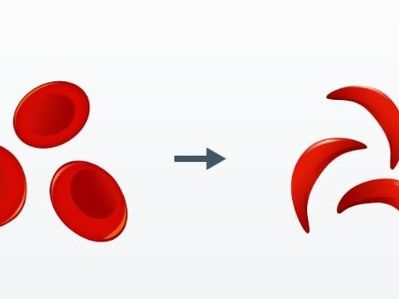 'सिकल सेल एनीमिया उन्मूलन मिशन' आनुवंशिक रोग, समानता और सम्मान को नियंत्रित करने की गारंटी: पीएमओ